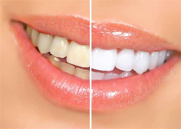 بلیچینگ سفید کردن دندان‌ها