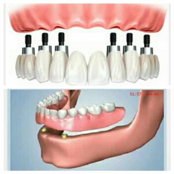 پروتزهای دهان و دندان